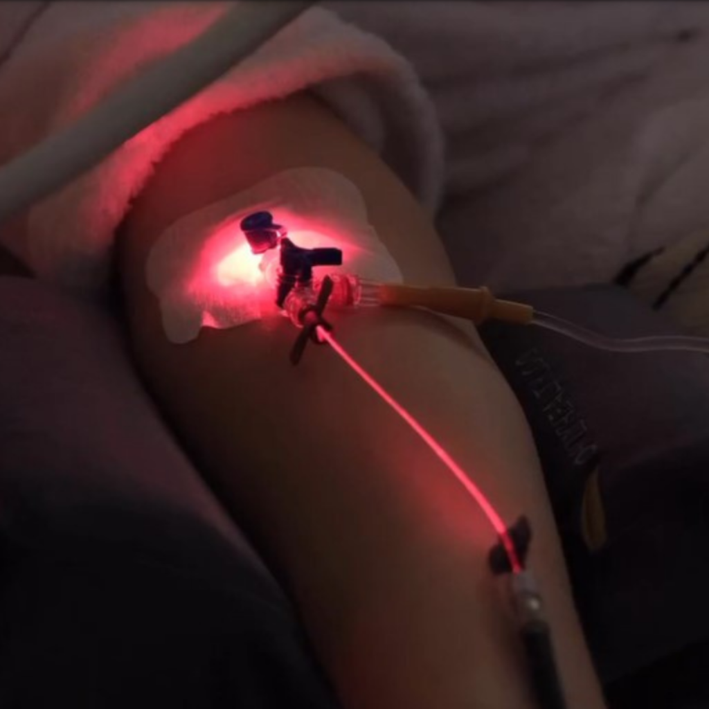 Intravenous Laser Therapy - 